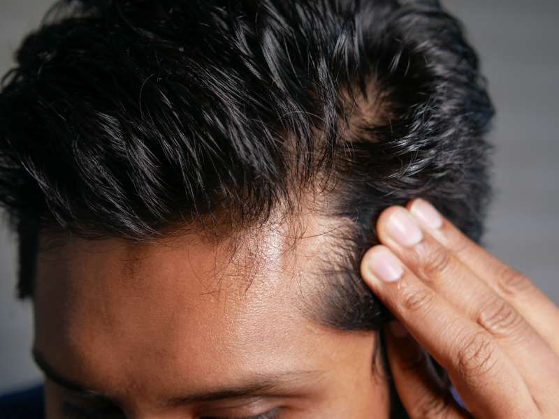 Mens Hair Loss Solutions Finding the Right Toupee